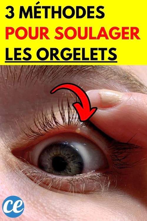 Une personne ayant un orgelet dans sa paupière