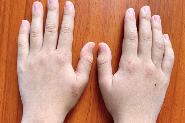 Mains enflées présentant des rougeurs et des plaques.