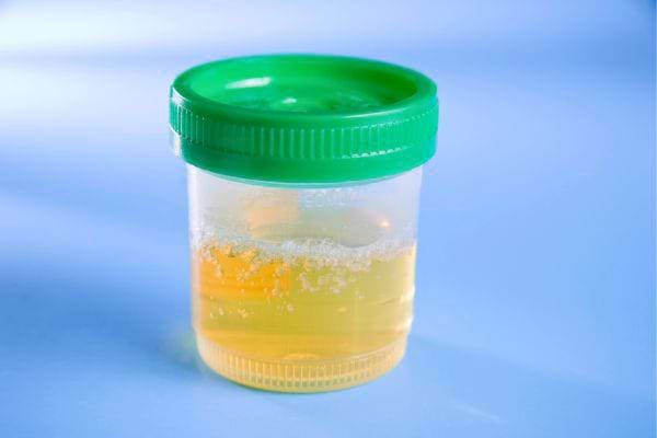 Un récipient de laboratoire contenant de l'urine avec des sédiments visibles.