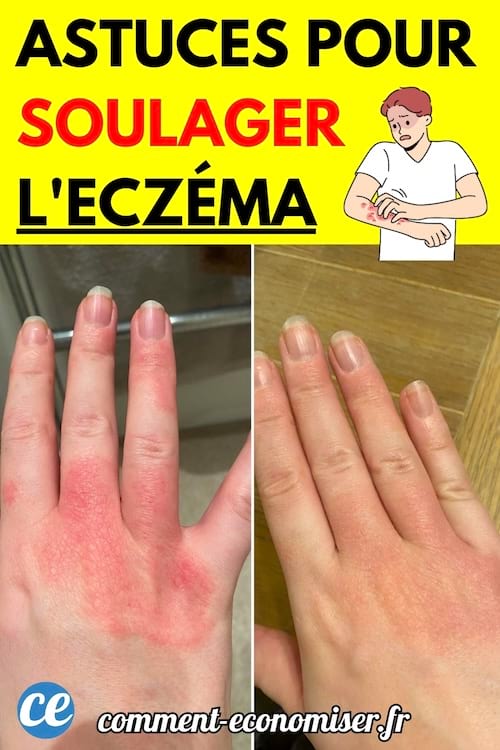 Deux photos d’une main avant et après un traitement contre l’eczéma