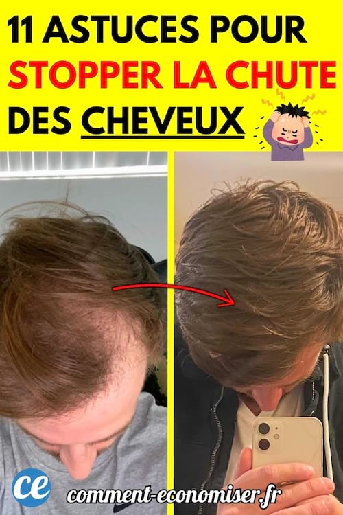 Avant-après d’un homme montrant une repousse des cheveux.