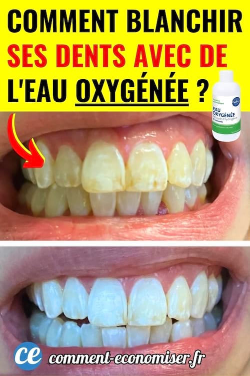 Dents jaunes et blanches apr&egrave;s en utilisant de l'eau oxyg&eacute;n&eacute;e