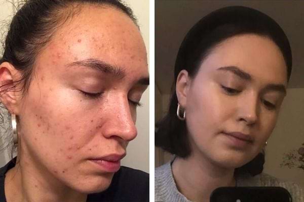 Avant/après sur peau à imperfections traitée à la vaseline.