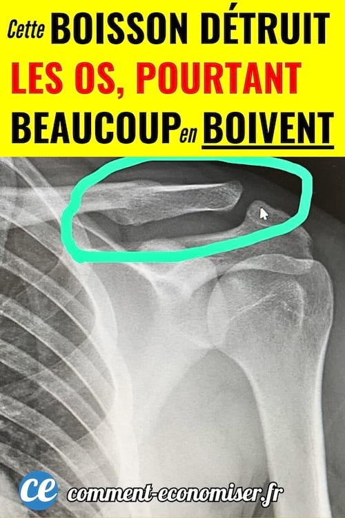 Une radiographie avec un os cassé d'une personne qui buvait du coca