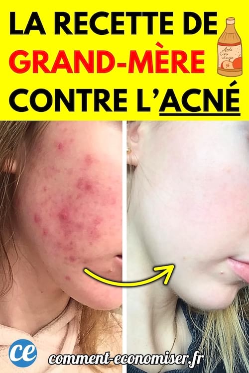 Avant-après du visage d'une jeune femme : à gauche, joue marquée par de l'acné rouge et inflammée ; à droite, même joue visiblement nette et apaisée.