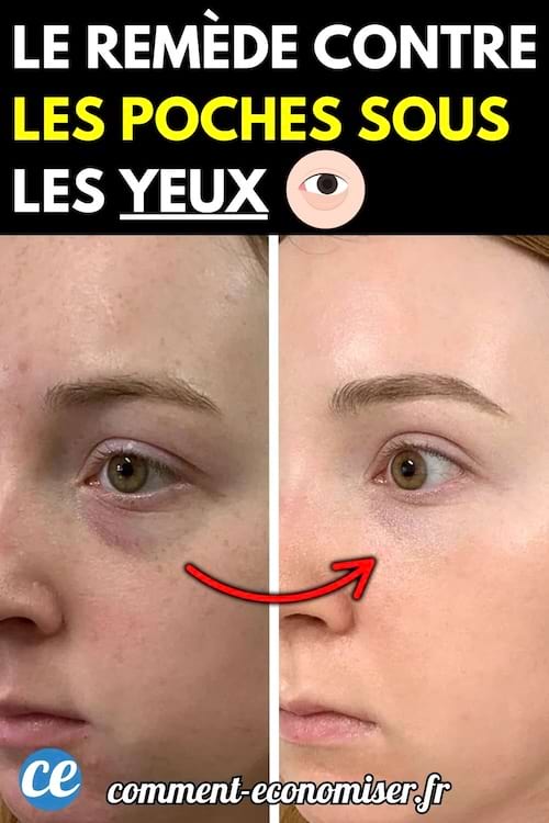 Avant-après d'une femme ayant utilisé un remède contre les poches sous les yeux, montrant une réduction visible des cernes.