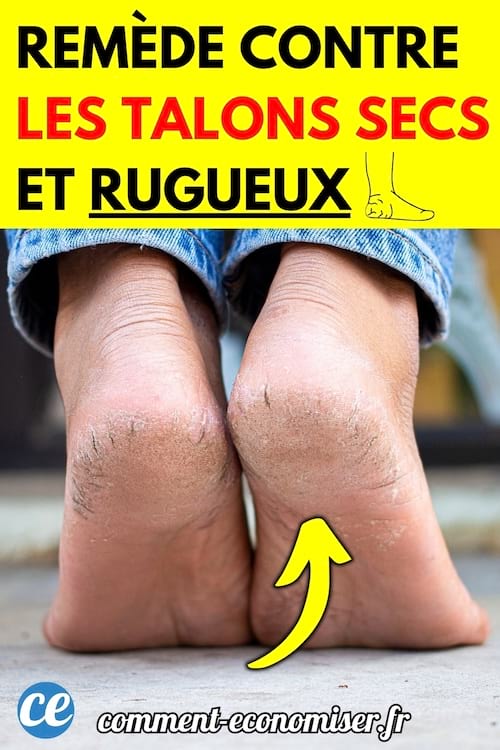 Des talons secs et fissurés d'une personne pieds nus.