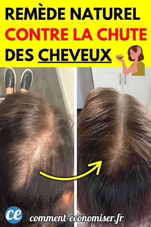 Avant/après d’un cuir chevelu féminin avec perte de cheveux visible à gauche, et des cheveux visiblement plus denses à droite.