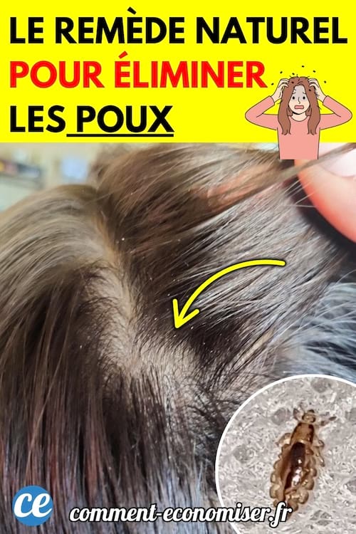 Une chevelure écartée pour révéler le cuir chevelu infesté de poux.