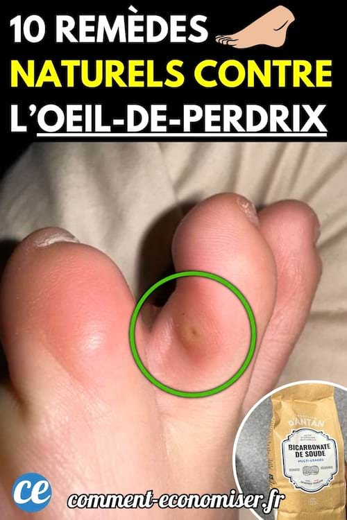 Un pied avec un œil-de-perdrix entre deux orteils.