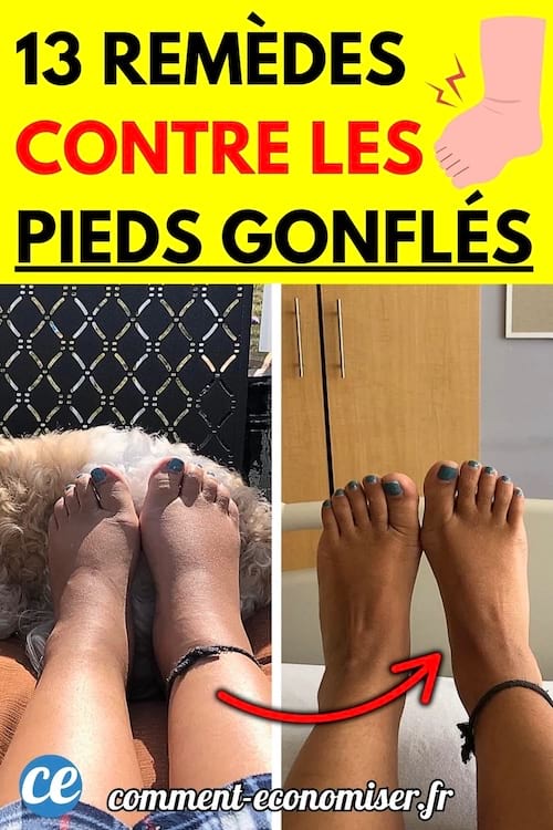 Avant-après de pieds enflés : à gauche, des pieds visiblement gonflés allongés sur un canapé ; à droite, les mêmes pieds dégonflés.