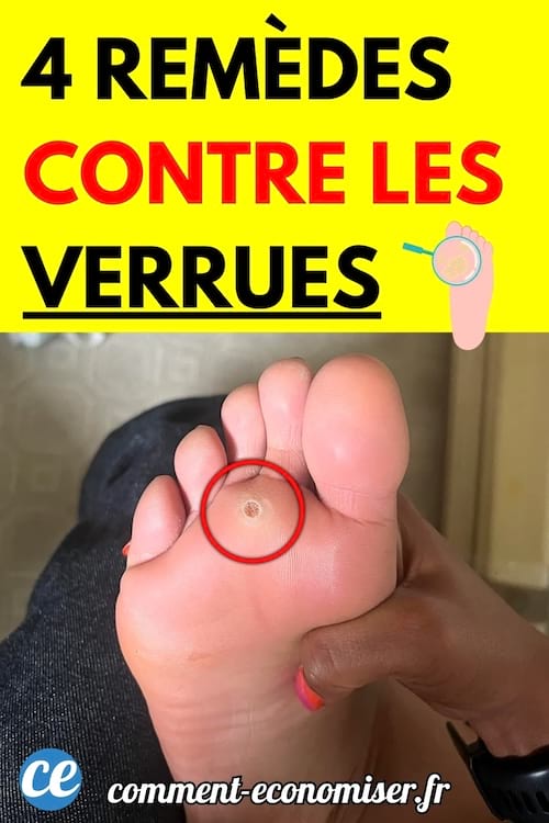 Un pied avec une verrue plantaire.