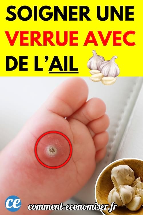Un pied avec une verrue plantaire, située sur la plante des orteils.