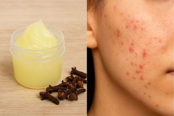 Vaseline au clou de girofle contre l’acné sur le visage.