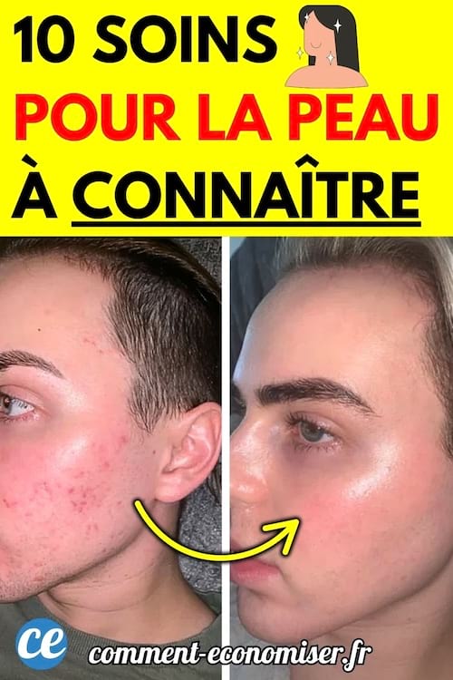 Avant-apr&egrave;s d'un homme ayant suivi des soins pour la peau, avec une nette am&eacute;lioration de l'acn&eacute; et du teint.