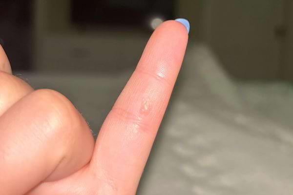 Doigt avec une petite irritation cutanée.