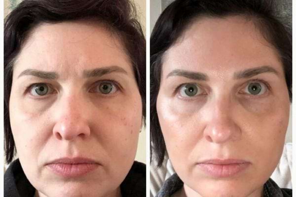 Avant-après d’un soin visage, peau plus lisse et éclatante.