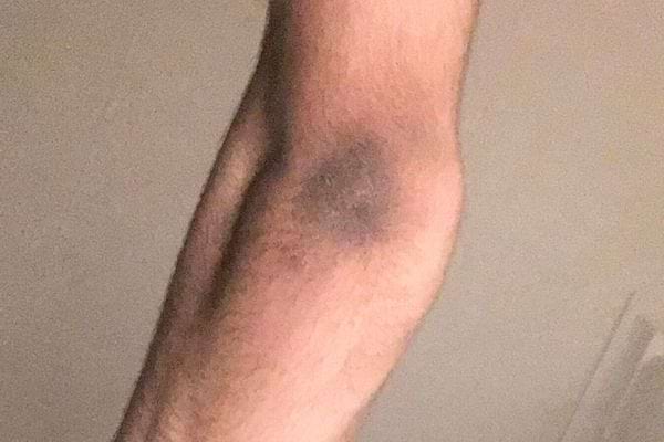 Grosse ecchymose sur une jambe.