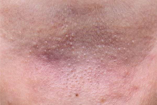 Boutons serrés et peau foncée sur le front, typique d’une hyperpigmentation.