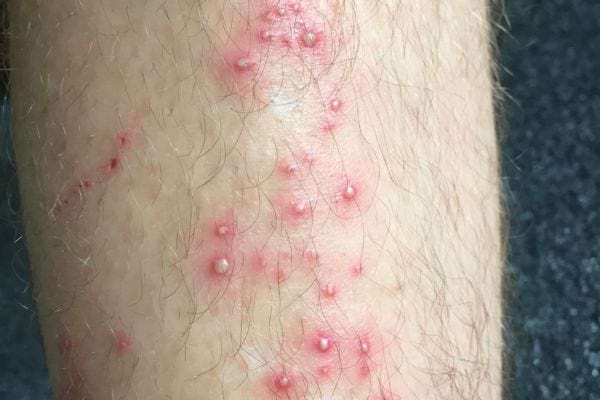 Boutons rouges avec du pus sur la jambe, suggérant une folliculite.