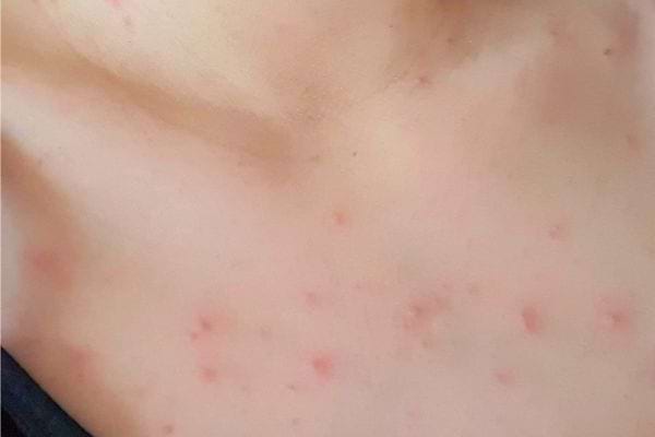 Petits boutons rouges sur la poitrine, caractéristiques de l’acné.