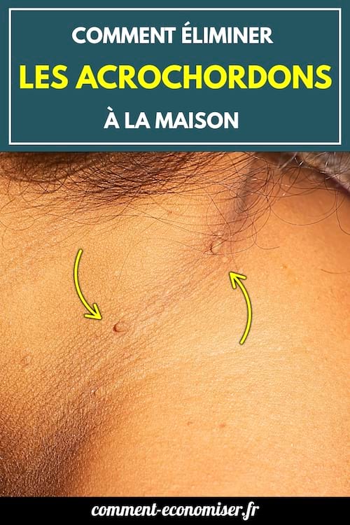 Gros plan sur une peau foncée avec plusieurs acrochordons visibles.