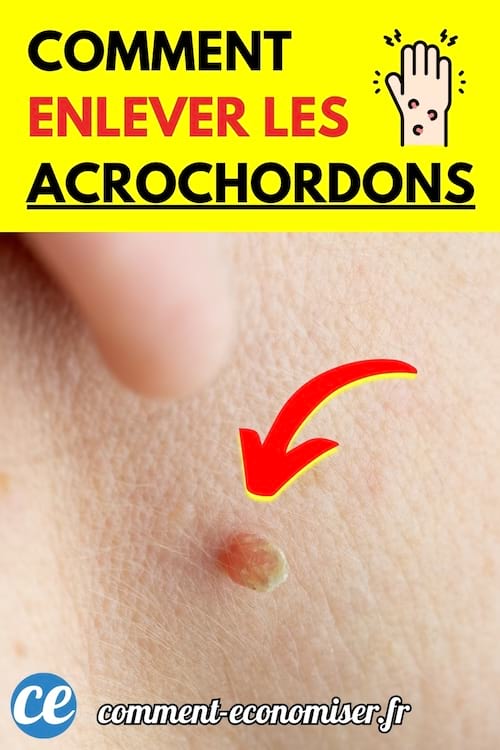 Acrochordon sur la peau humaine avec une flèche rouge pointant dessus.