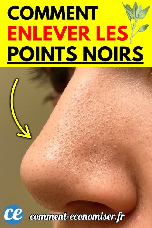 Gros plan sur un nez présentant des points noirs visibles.