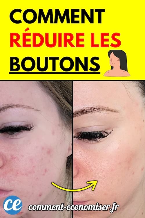Visage d’une femme avec une peau acnéique à gauche et une peau lisse à droite, montrant un avant/après.