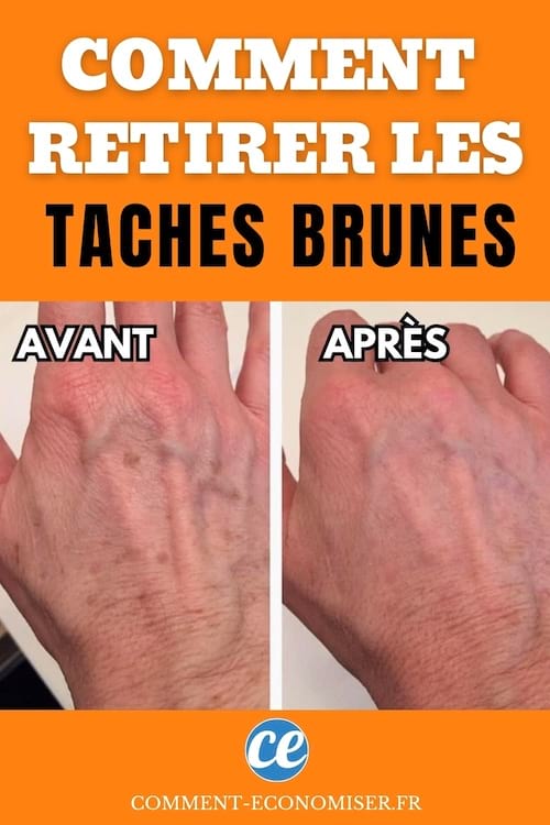 Deux photos comparatives montrant le dos d’une main avec des taches brunes avant et après traitement.