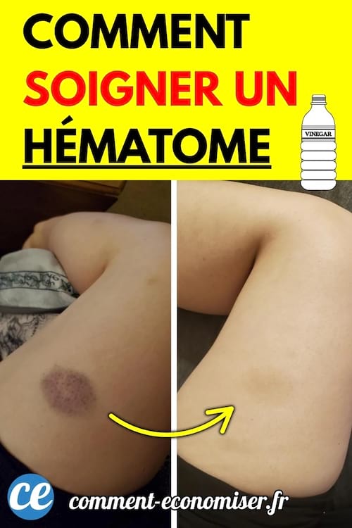 Comparaison avant/après d’un hématome sur la cuisse, visible à gauche, disparu à droite.