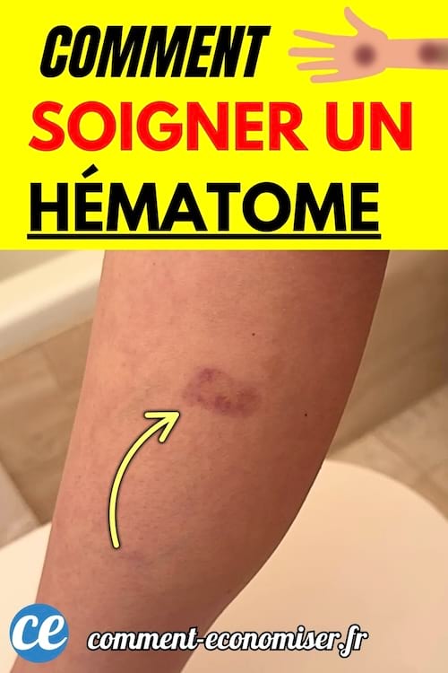 Avant-bras avec un hématome violet au niveau du muscle, entouré d’une flèche.
