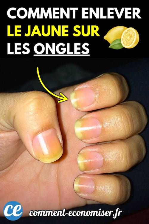 Des ongles jaunis d’une main, mis en évidence par une flèche jaune sur fond sombre.