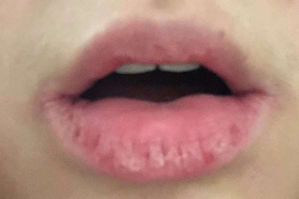 Lèvres très sèches et gercées.