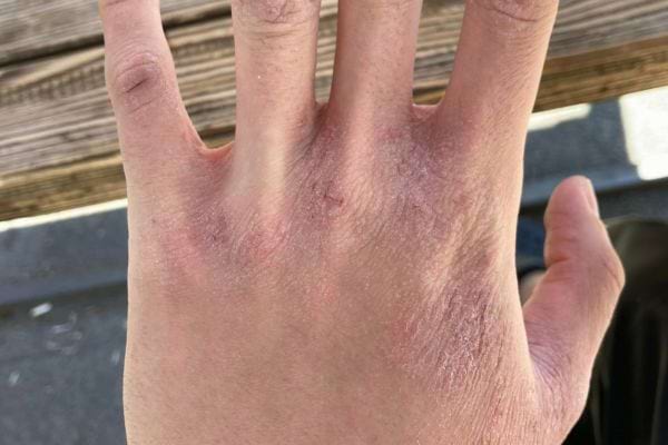 Main rouge et sèche avec irritation visible.