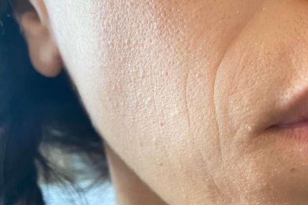 Peau du visage montrant des ridules de déshydratation.