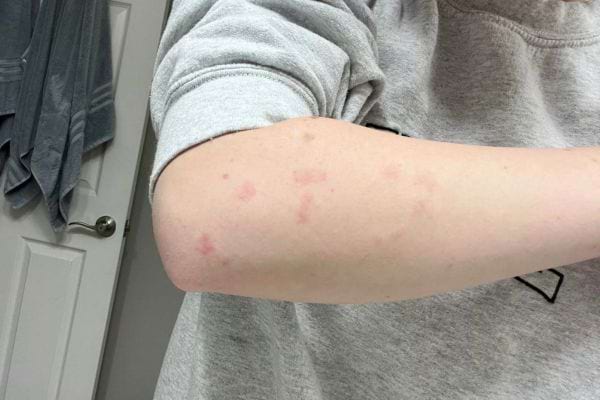 Petites plaques rouges dispersées sur l’avant-bras.