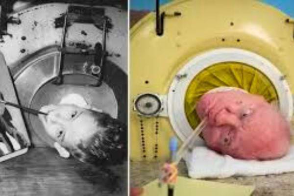 Enfant puis adulte allongé dans un poumon en acier pour respirer.