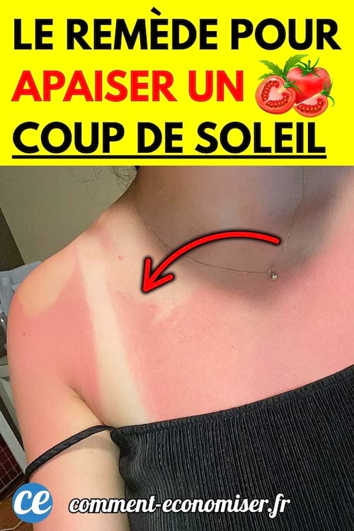 Épaule et haut du torse d’une personne souffrant d’un coup de soleil marqué, avec une zone de peau rouge vif contrastant avec une zone restée blanche.