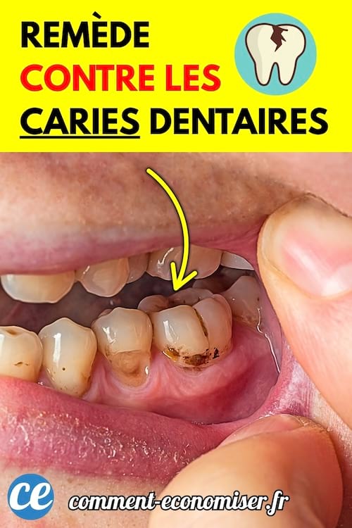 Gros plan sur une dent cariée dans une bouche ouverte.