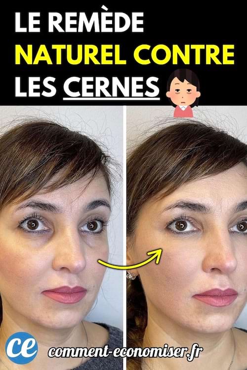 Avant-après d’un remède naturel contre les cernes : deux photos d’une femme montrant une nette réduction des cernes sous les yeux.