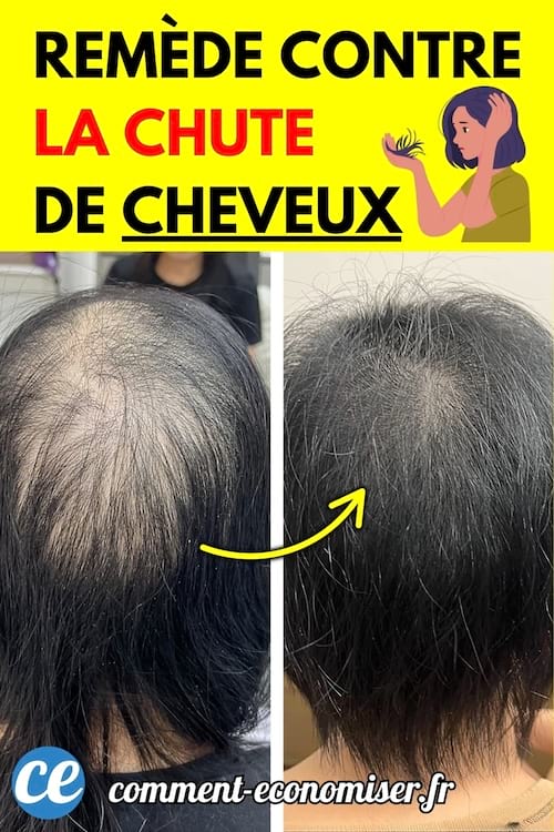Avant-après d’un cuir chevelu avec chute de cheveux, montrant une nette repousse après un remède naturel.