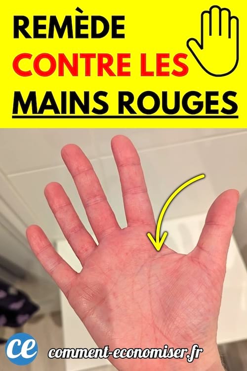 Main ouverte avec la paume rouge et une flèche jaune pointant vers une irritation cutanée