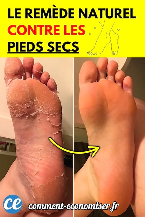 Avant/après montrant un pied sec et craquelé à gauche, et un pied doux et hydraté à droite.