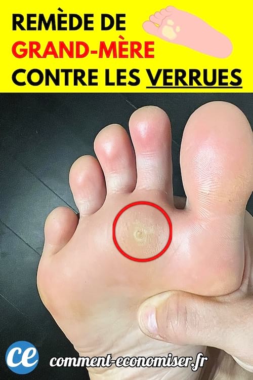 Gros plan sur un pied avec une verrue plantaire encerclée en rouge.