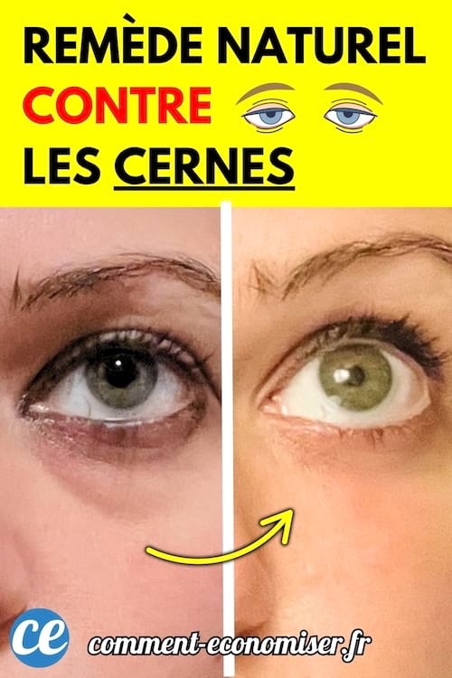 Vue rapprochée des yeux d’une femme, avec une comparaison avant/après montrant une réduction des cernes.