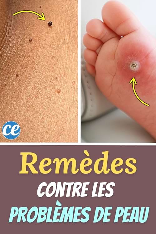 Plan rapproché d'acrochordons sur une peau et d'une verrue plantaire sur un pied d'enfant.