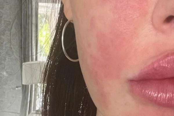 Rougeurs diffuses sur la joue, enflammées et irrégulières.