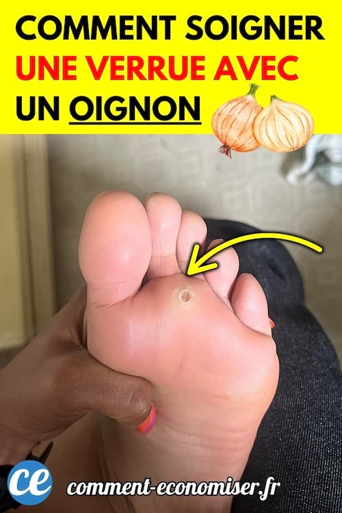 Un pied avec une verrue plantaire visible sous un orteil.