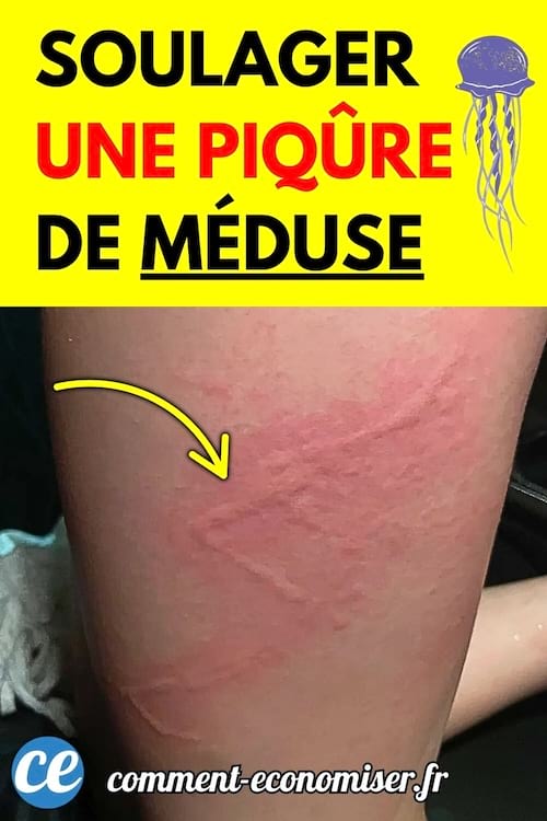 Peau rouge et marquée par une piqûre de méduse sur une jambe.
